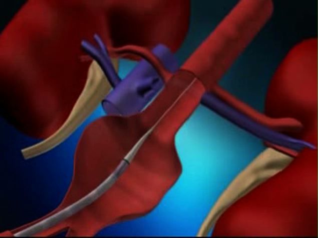 What is endovascular surgery?