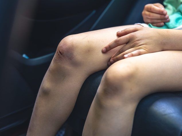 Manchas roxas pelo corpo sem motivo: quando podem indicar um problema de saúde?